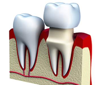 purpose of dental crowns