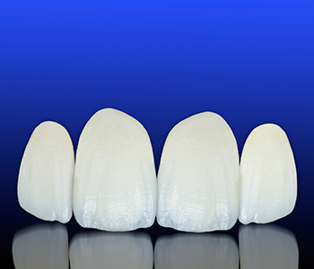 Brampton offers porcelain veneers