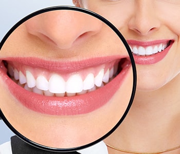 Teeth Whitening in Brampton