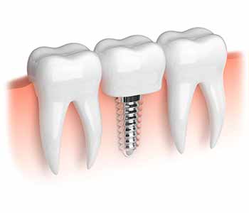 Dr. Joshi and his team’s dental implants procedure to rebuild teeth in Brampton