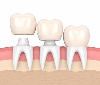 Dental crowns treatment in Brampton - Full crowns fit over the entire tooth