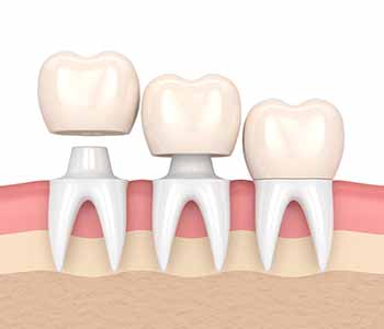 Dental crowns treatment in Brampton - Full crowns fit over the entire tooth