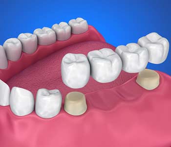 Tooth supported fixed bridge. Medically accurate 3D illustration