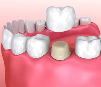 Dental crown installation process, Medically accurate 3d illustration