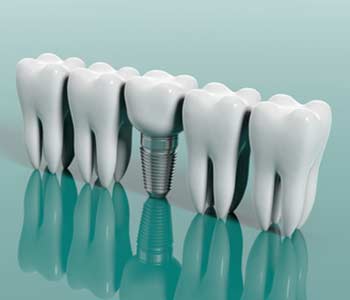 Teeth and dental implant isolated on green background. 3d illustration
