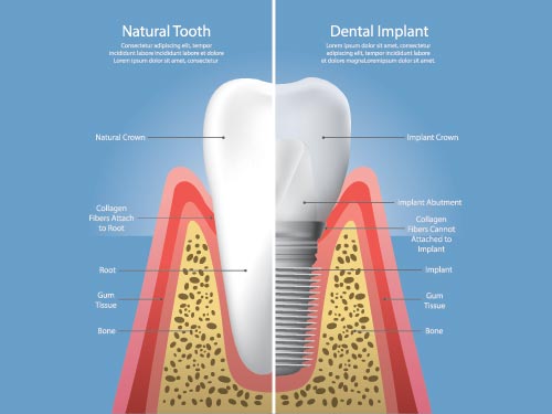 Dental implants from your Brampton dentist restores appearance, function and much more!