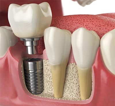 Dental Implant at Kensington Dental